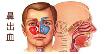 专家教你预防鼻出血