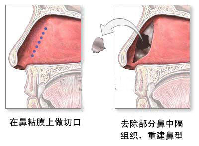 鼻内窥镜 快速无痛治疗鼻中隔偏曲